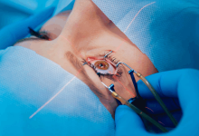 ai-driven-laser-eye-surgery:-how-blue-fin-vision-refines-outcomes-through-smart-surgical-planning